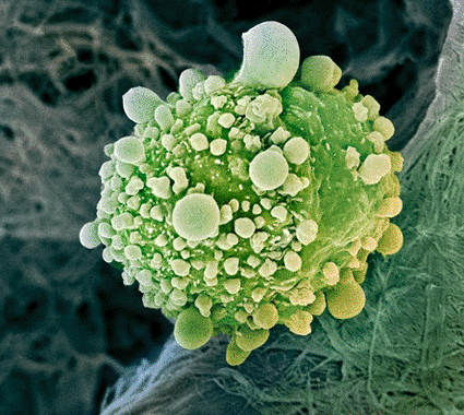 Image: Colored scanning electron micrograph (SEM) of a pancreatic cancer cell (photo courtesy Steve Gschmeissner / SPL).